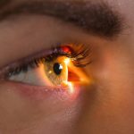 Glaucoma-