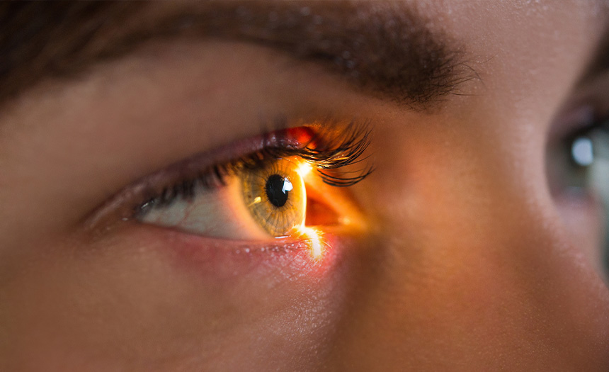 Glaucoma-