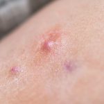 hidradenitis