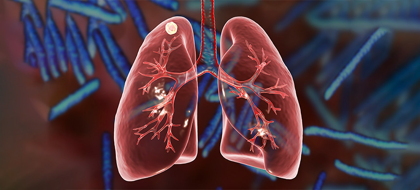 tuberculosis