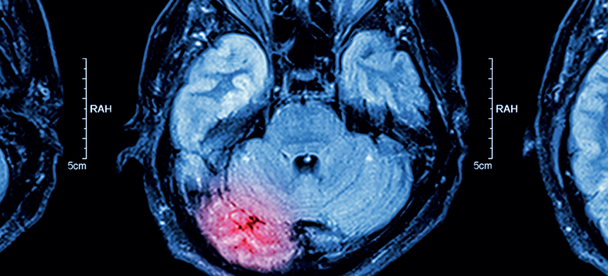 lesiones cerebrales